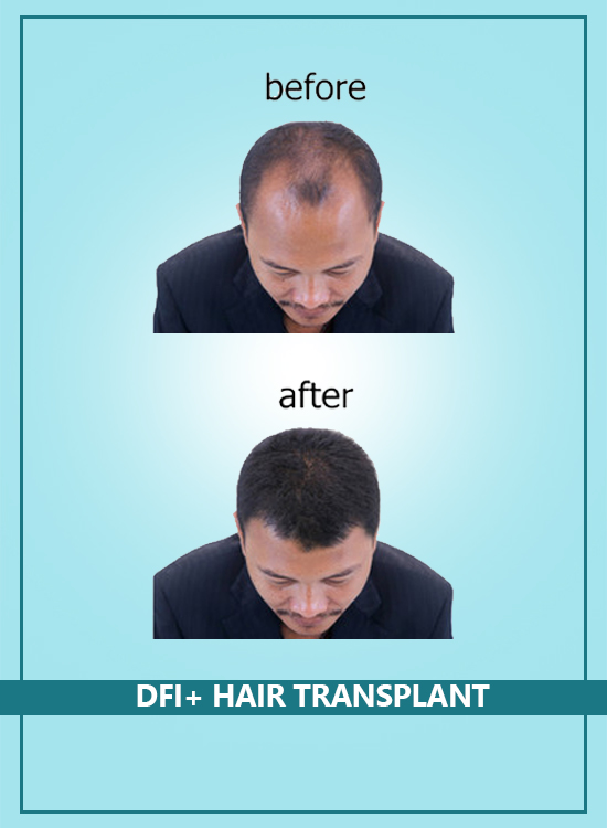 DFI+ Hair Transplant in India|Pune|Hyderabad|Bangalore|Vijayawada