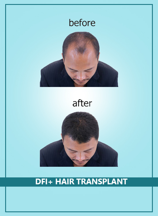 DFI+ Hair Transplant in India|Pune|Hyderabad|Bangalore|Vijayawada DFI+ Hair Transplant in India|Pune|Hyderabad|Bangalore|Vijayawada