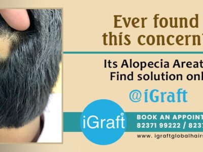 alopecia areata