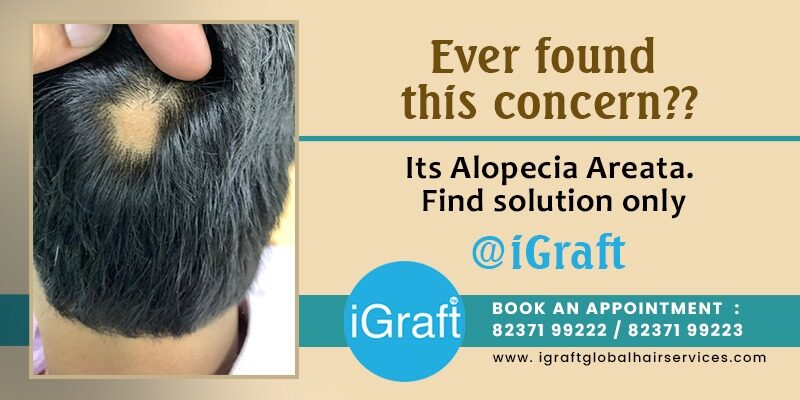 alopecia areata