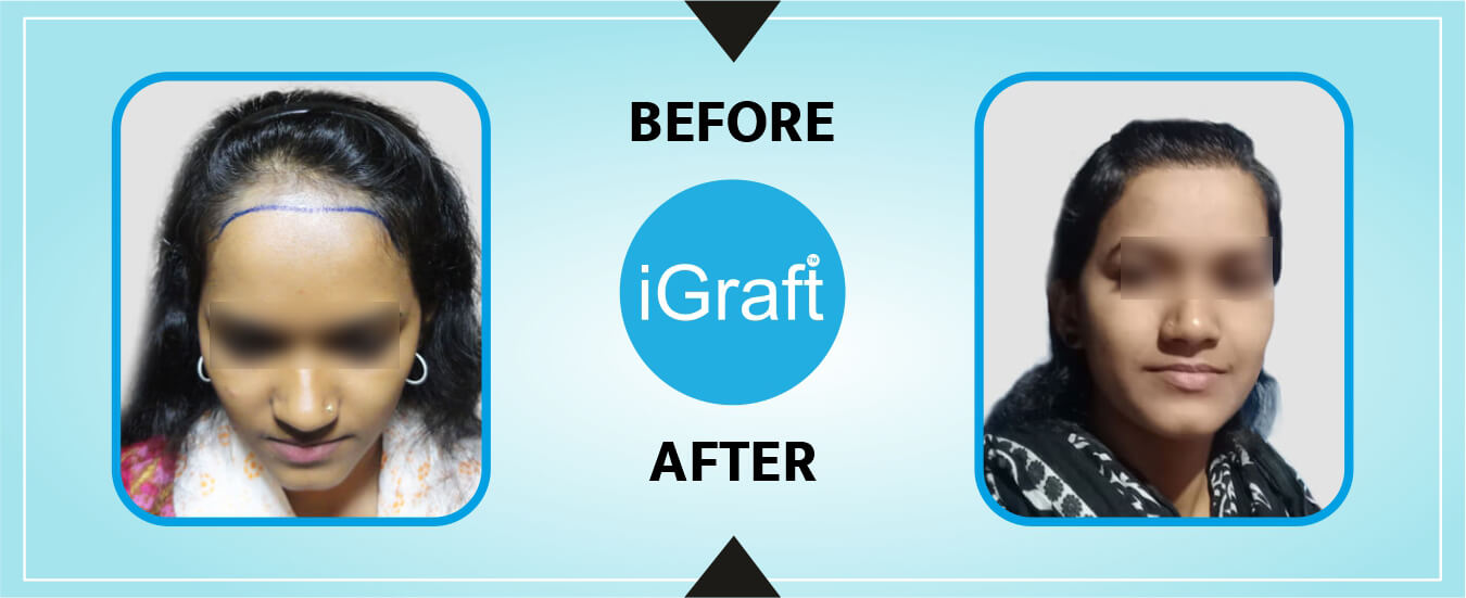 Igraft Reviews 