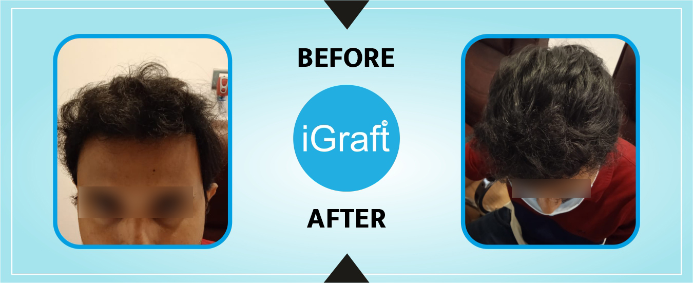 Before and After Hair Transplant - iGraft Global Pioneer in DFI Gen3 Hair  and Skin Treatments