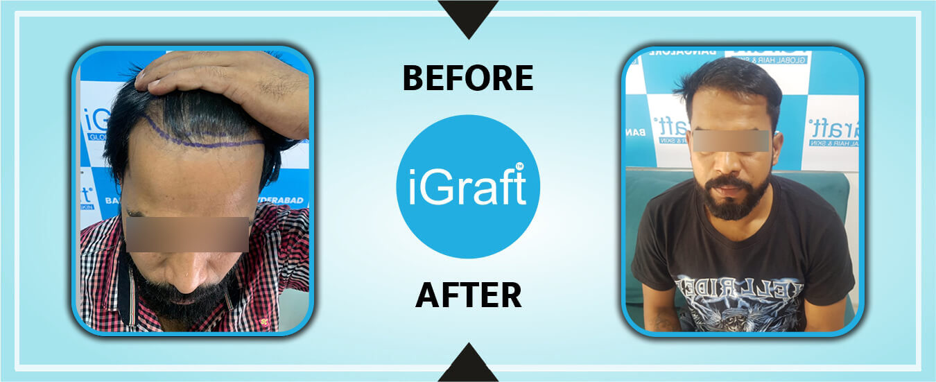 iGraft-Hair-Transplant-Result-Yuvraj-May21