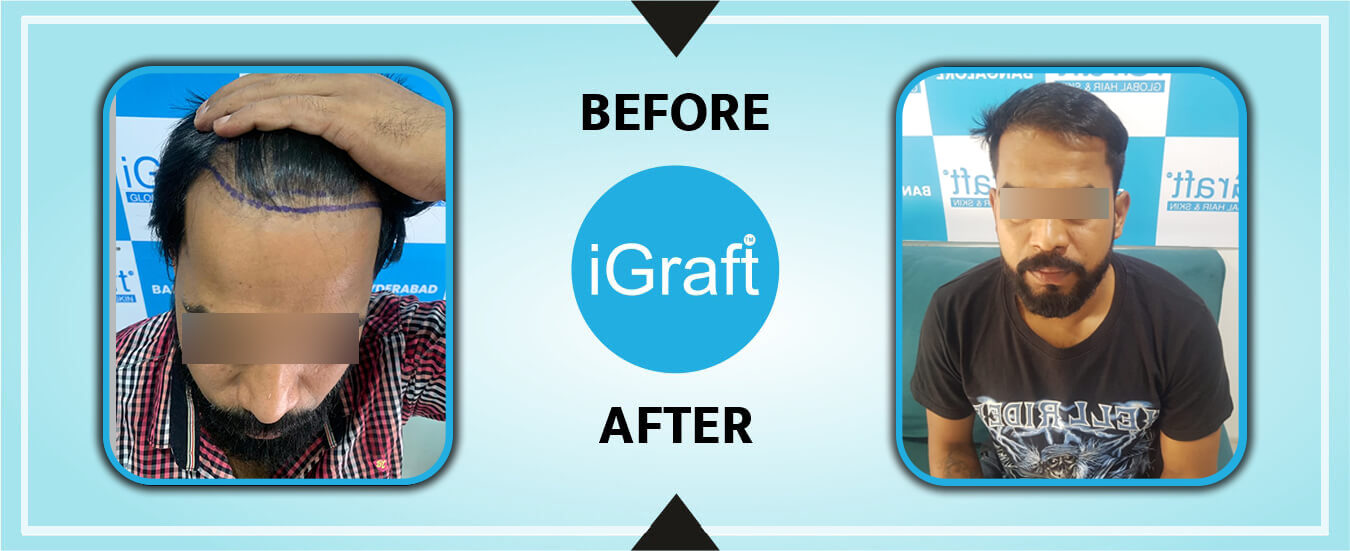 Igraft Reviews 