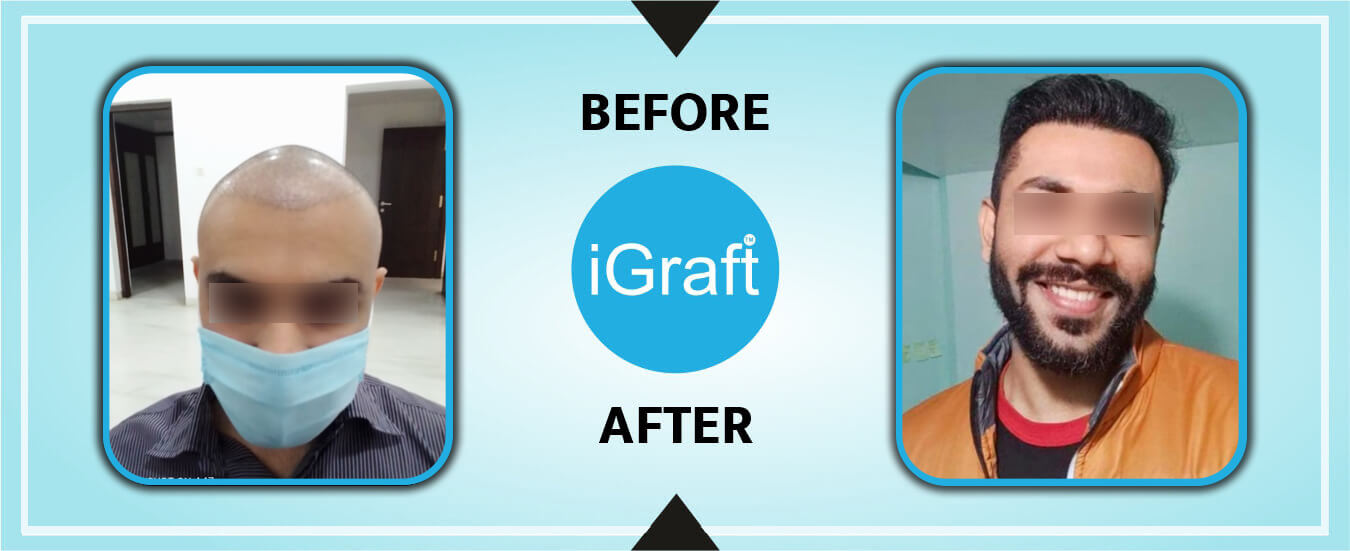 iGraft-Hair-Transplant-Result-Yuvraj-May21