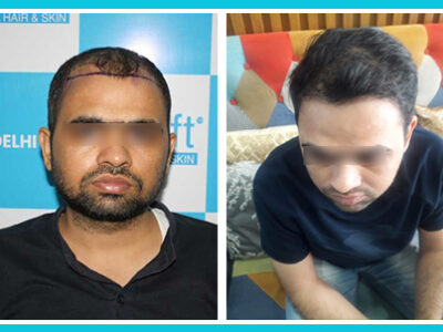 DFI Hair Transplant in iGraft Pune