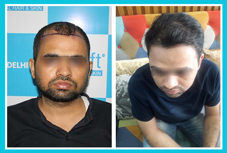 DFI Hair Transplant in iGraft Pune