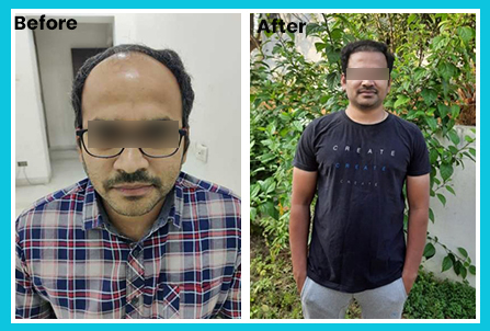 iGraft Hair Transplant Cost