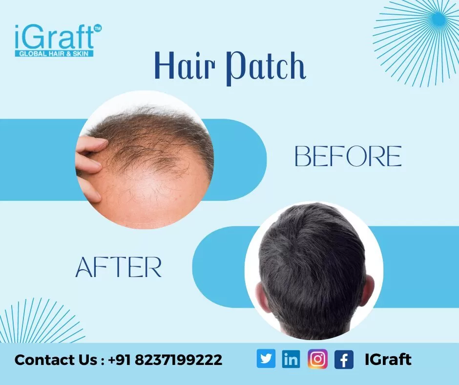 Before and after hair treatment results at iGraft