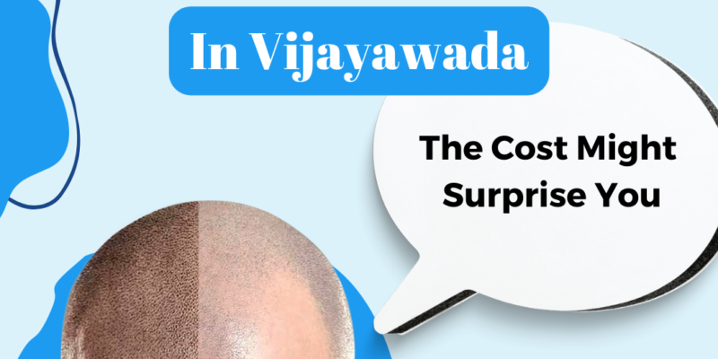 Hair Transplant in Vijayawada
