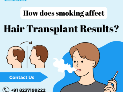 smoking affecting hair loss