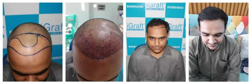 Is Hair Transplant Permanent and Safe?