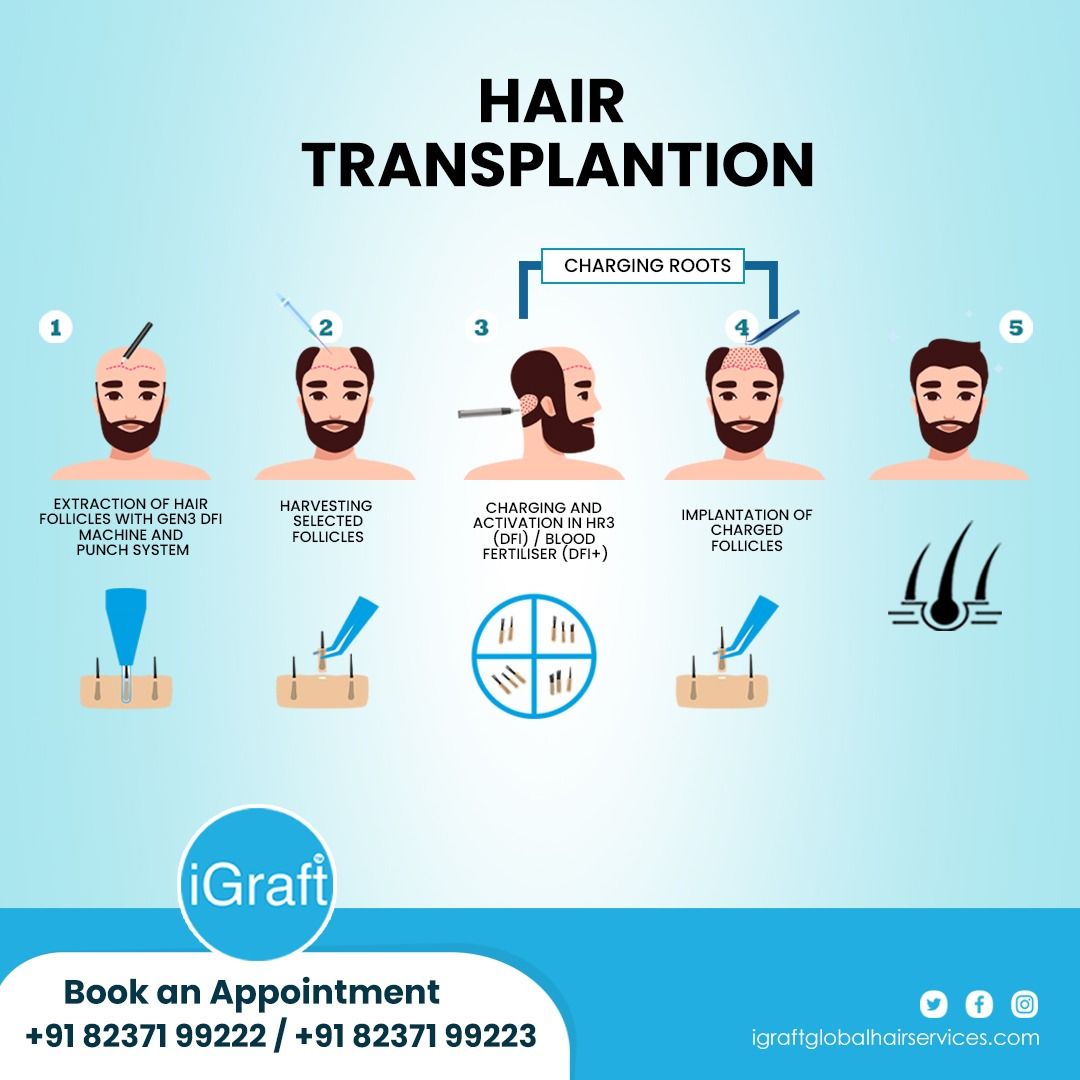 iGratf hair transplant procedure and case study