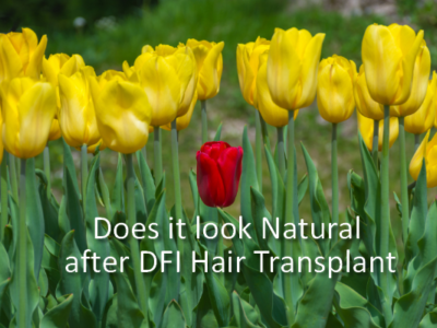 Natural looking hair transplant