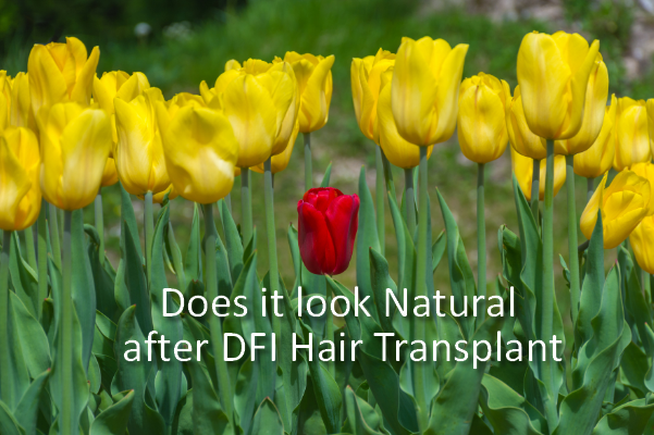 Natural looking hair transplant