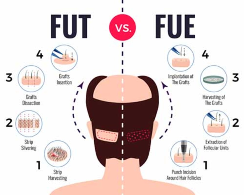 Best Hair Transplant Cost In Pune India