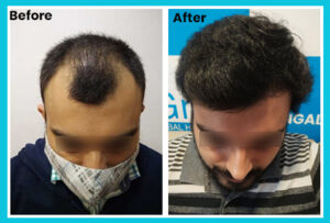 Best Hair Transplant Cost In Pune India