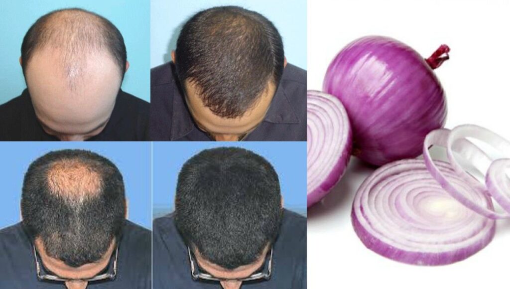 Onion Juice for Hair Growth