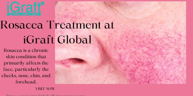 Rosacea Treatment at iGraft Global