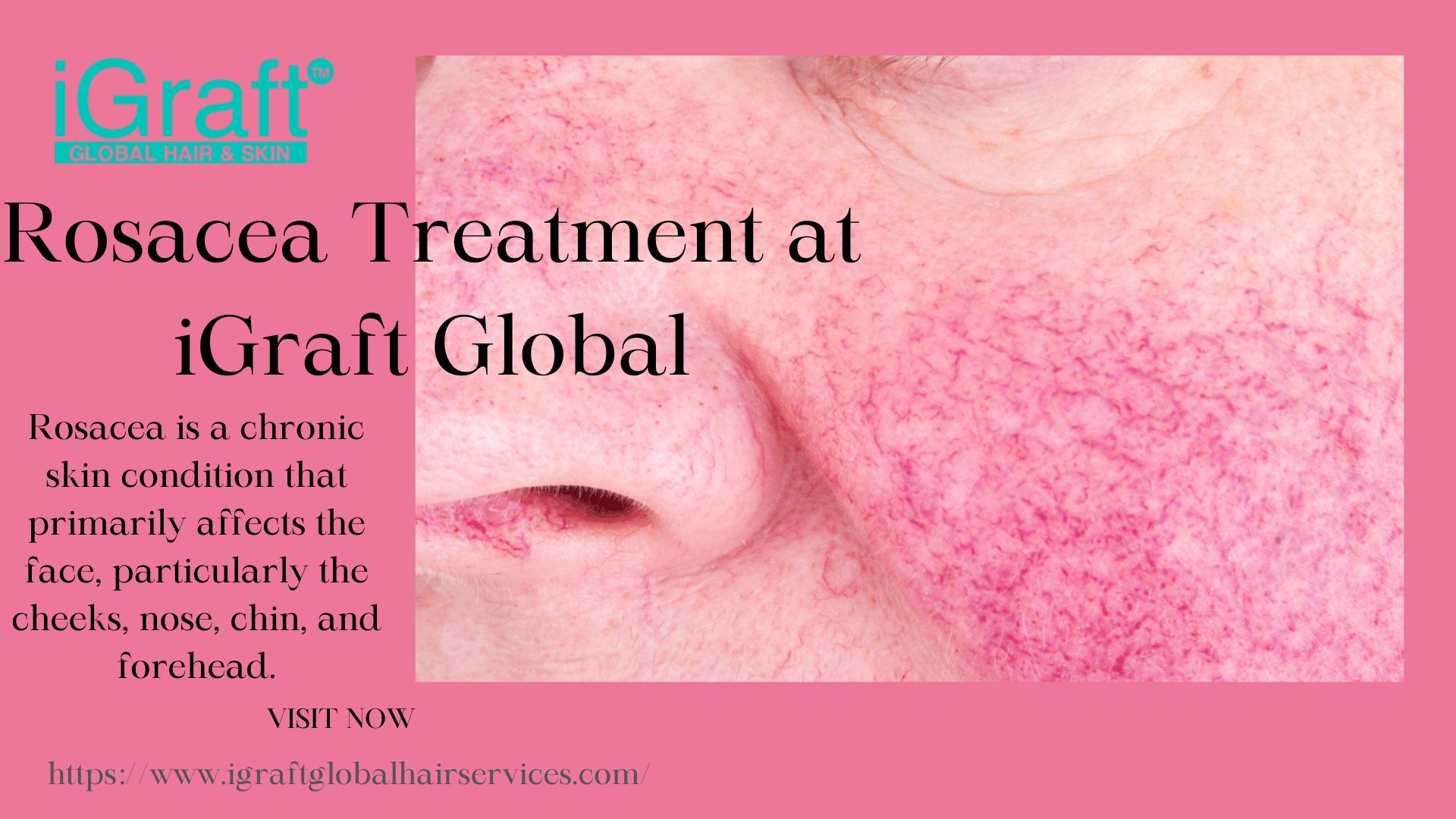 Effective Rosacea Treatment Options for Clearer Skin