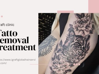 Tattoo Removal Treatment