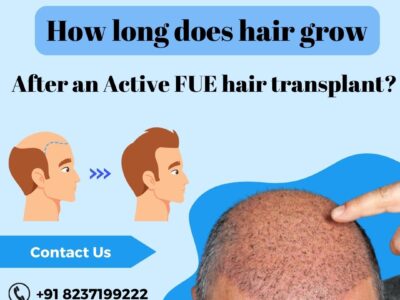 FUE hair transplant