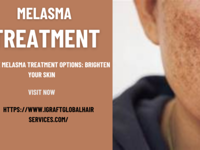 Melasma Treatment