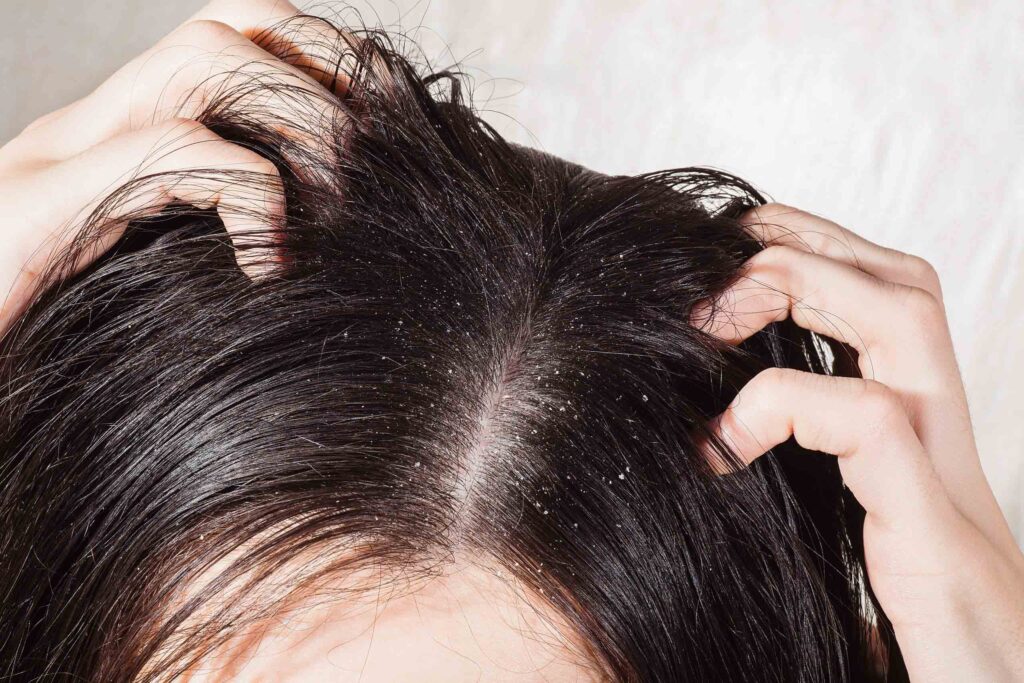 How to get rid of Minoxidil Flakes