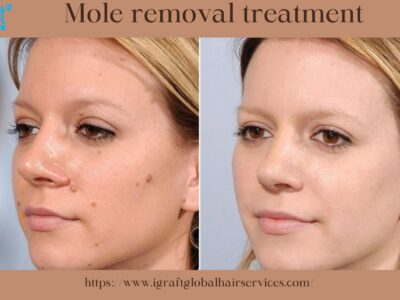 Mole removal treatment.