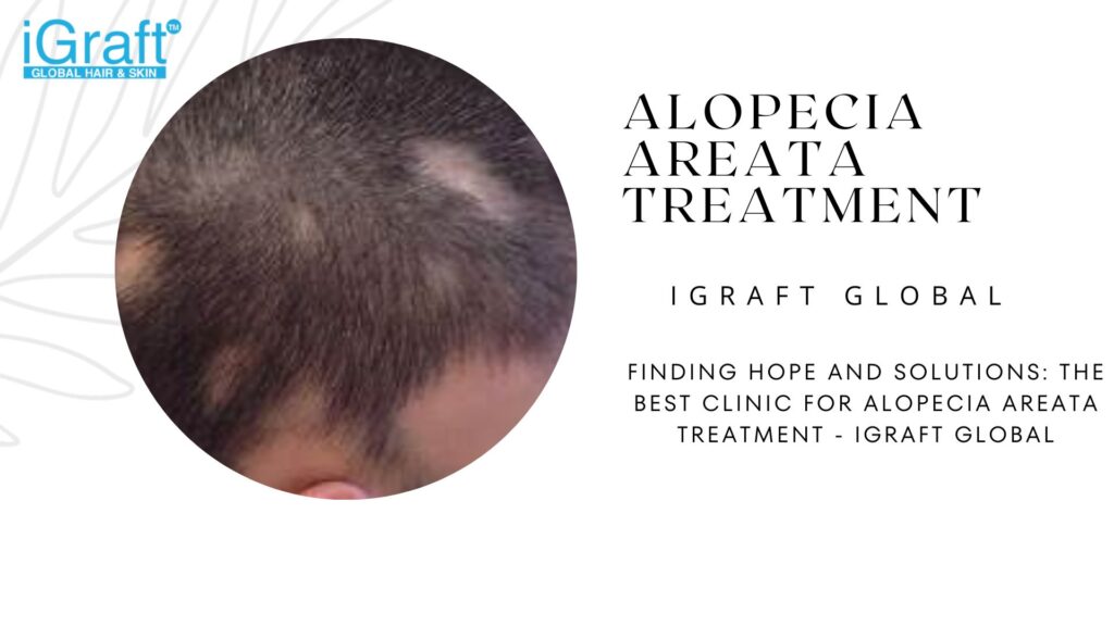 Alopecia Areata Treatment