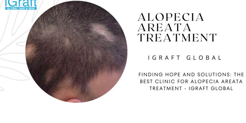 Alopecia Areata Treatment