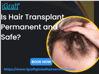 Is Hair Transplant Permanent and safe?