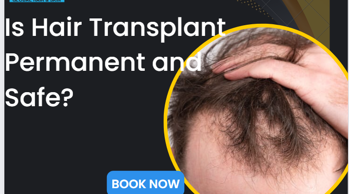 Is Hair Transplant Permanent and safe?