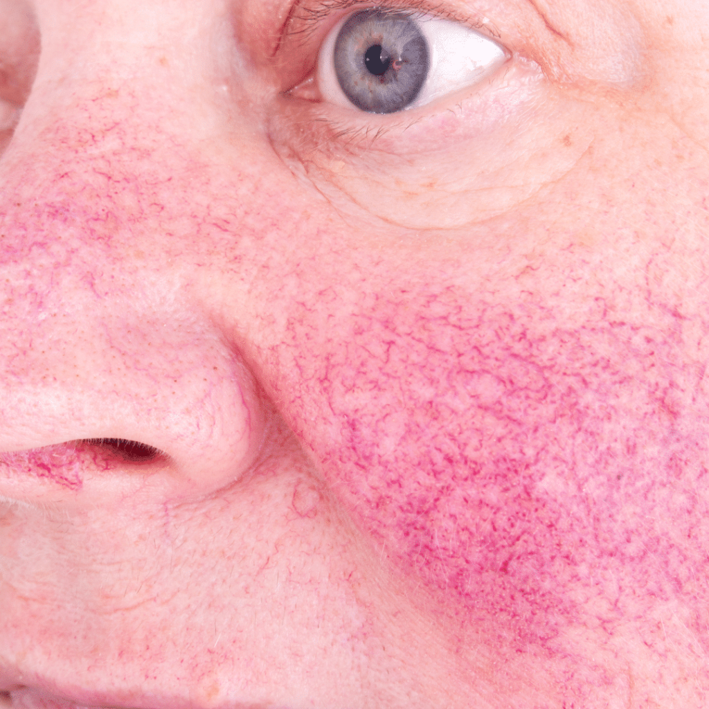 Rosacea Treatment at iGraft Global