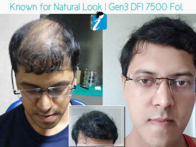 Best hair transplant in Bangalore