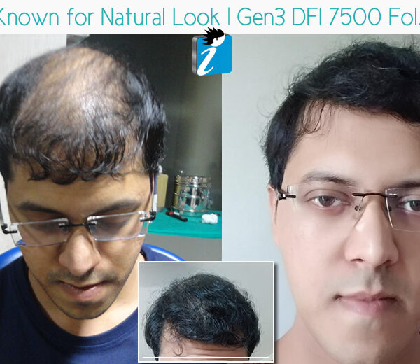 Best hair transplant in Bangalore