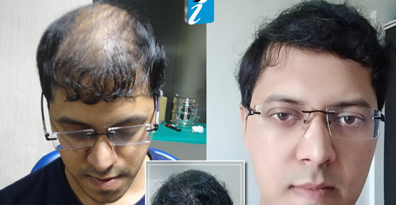 Best hair transplant in Bangalore