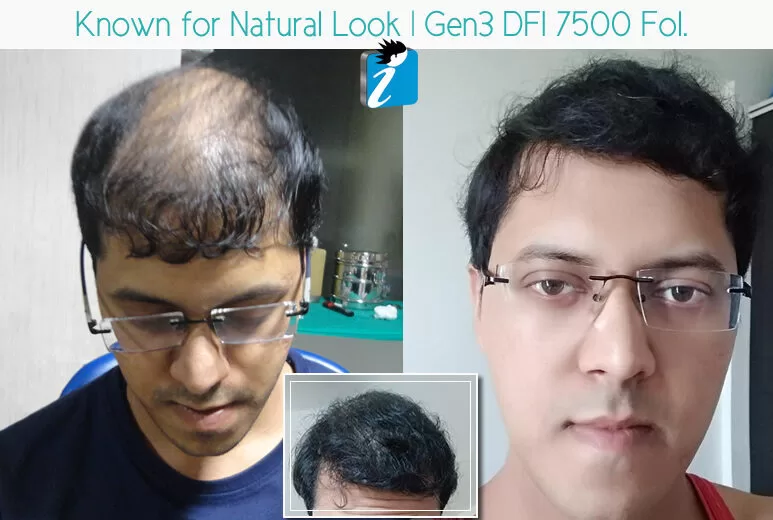 Best hair transplant in Bangalore
