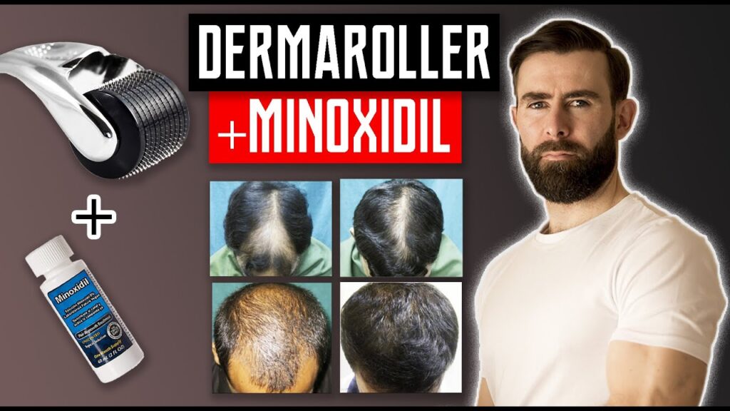 How to Use Minoxidil and Dermaroller Together