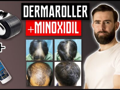 How to Use Minoxidil and Dermaroller Together