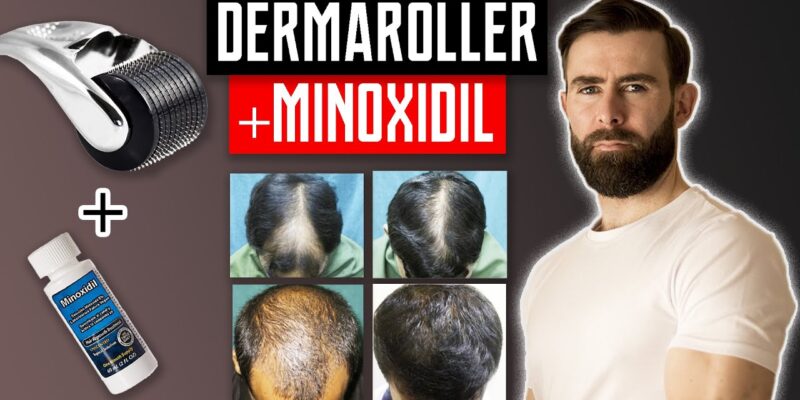 How to Use Minoxidil and Dermaroller Together