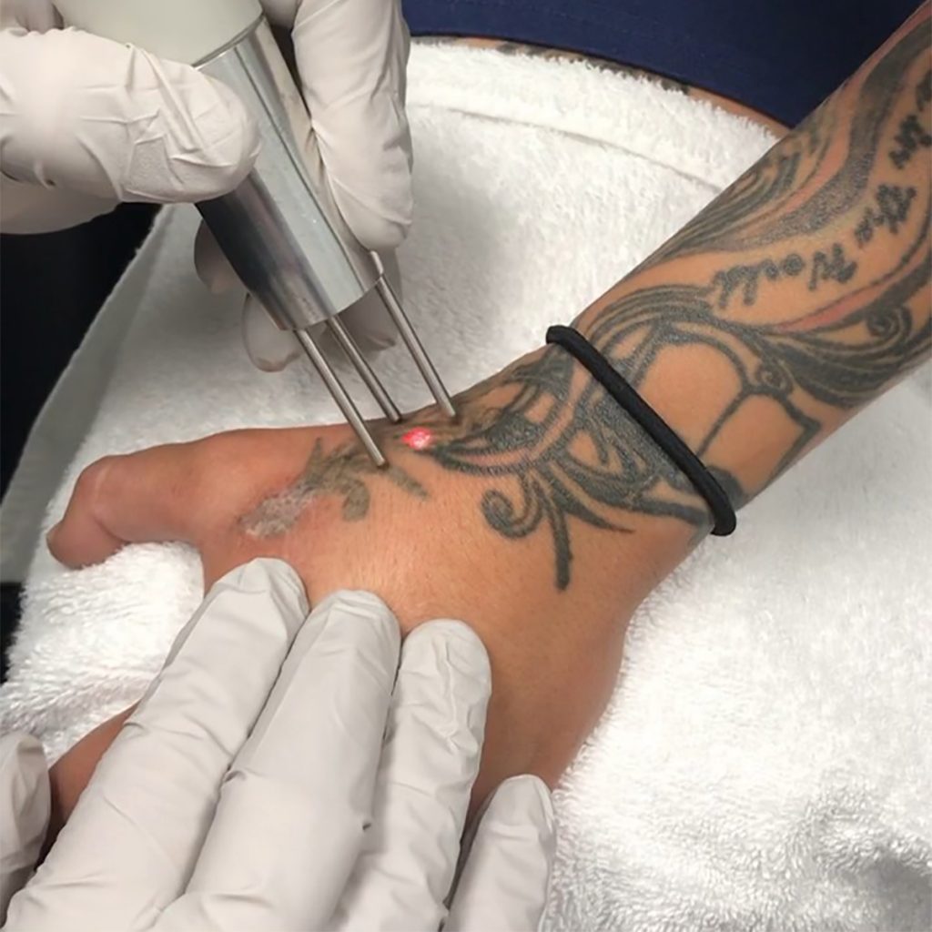 Tattoo Removal Treatment