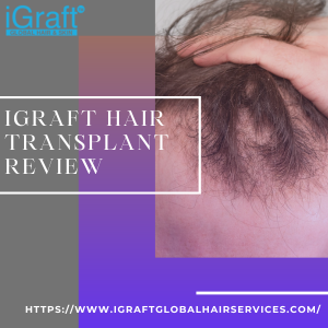 iGraft Hair Transplant Review