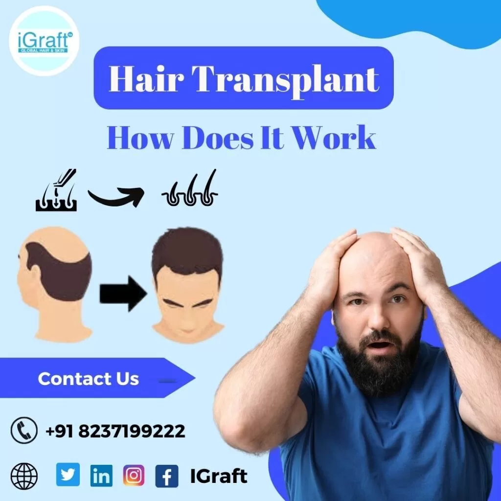 Hair Transplant : How does it work ?