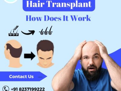 Hair Transplant : How does it work ?