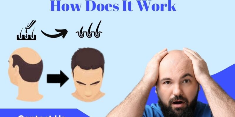 Hair Transplant : How does it work ?