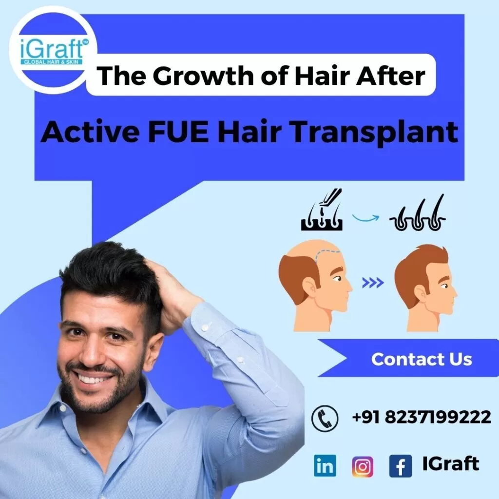 Active FUE hair Transplant