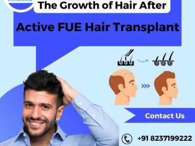 Active FUE hair Transplant