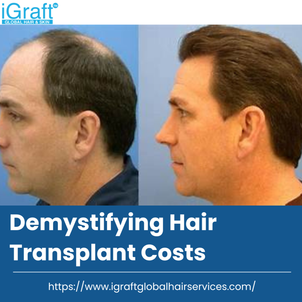 Hair Transplant Costs on Quora