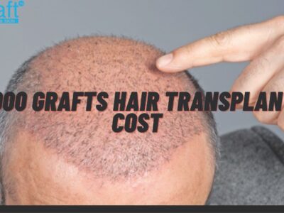 2000 grafts hair transplant cost